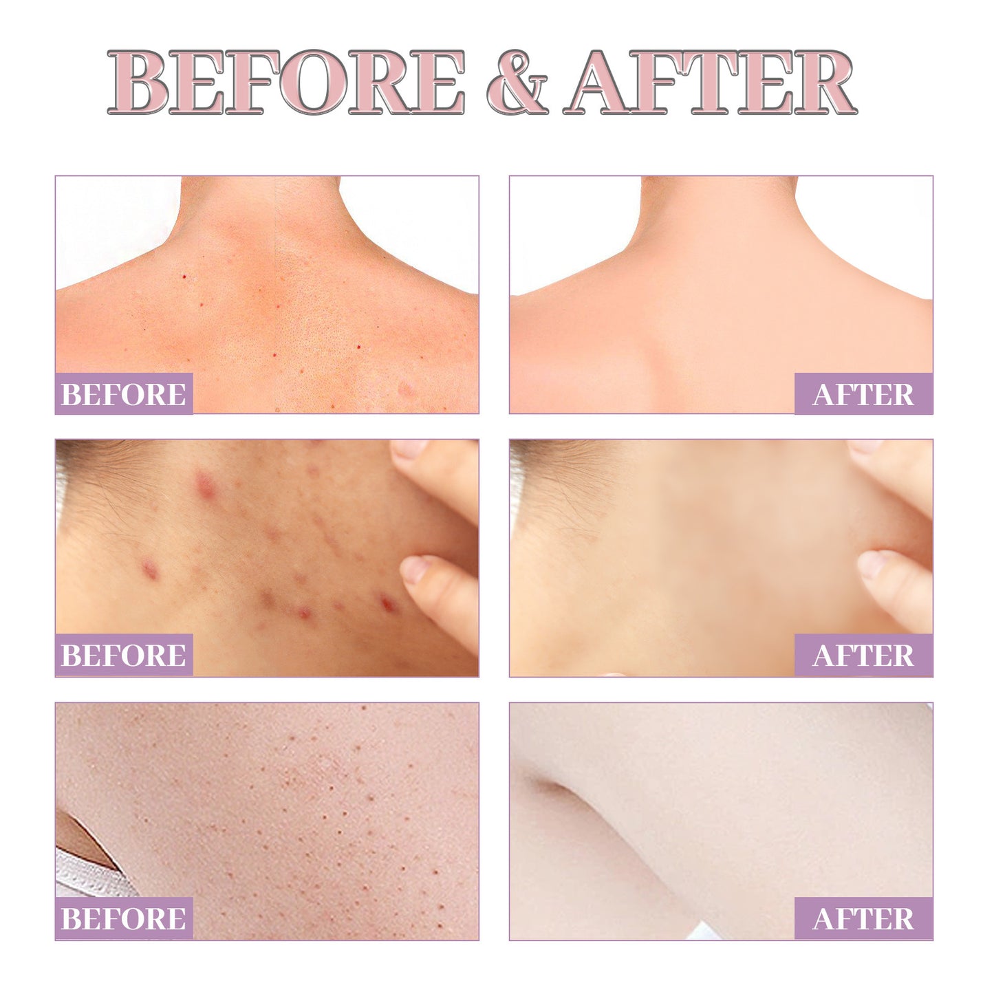Chest & Back Cleansing Fade Acne Print Skin Care Ball