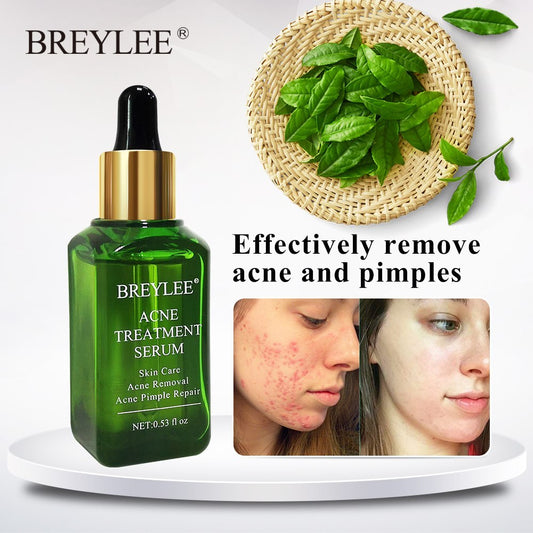 Facial Acne Treatment Serum