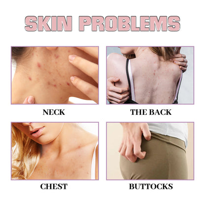 Chest & Back Cleansing Fade Acne Print Skin Care Ball