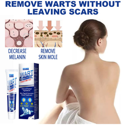 Wart Removing Cream